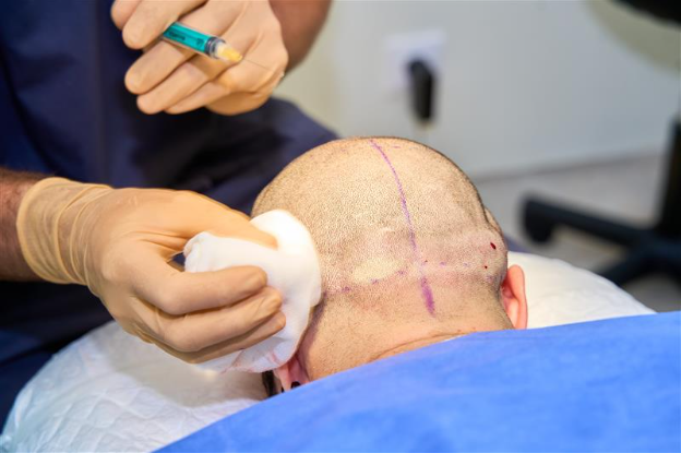 Surgeon administering injection to patient&rsquo;s head during hair transplant