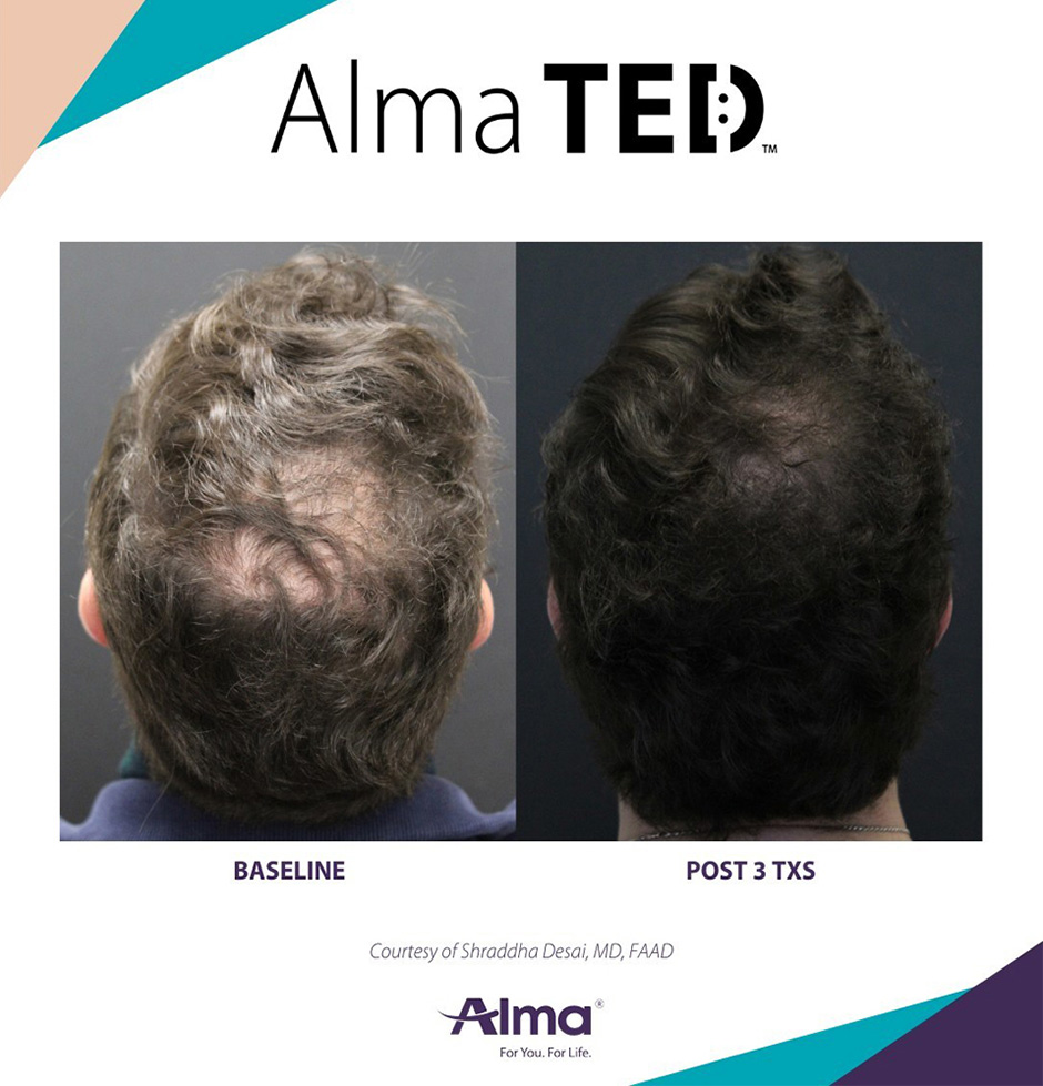 alma ted mens non surgical treatment 5