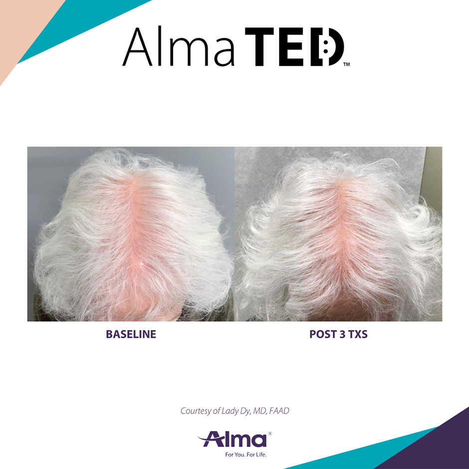 alma ted womens non surgical treatment 3