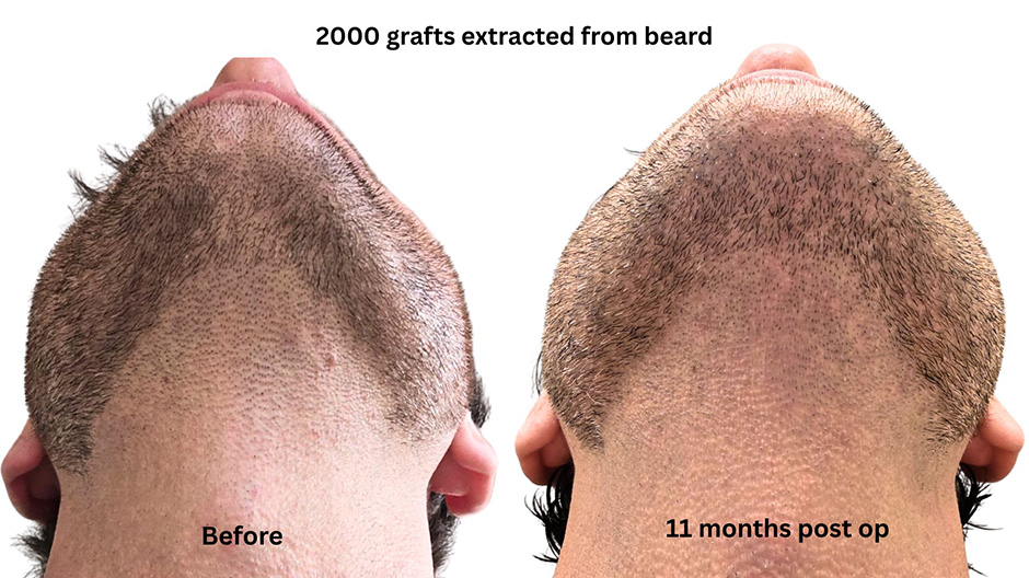 2,000 grafts extracted from beard 2,000 grafts extracted from beard