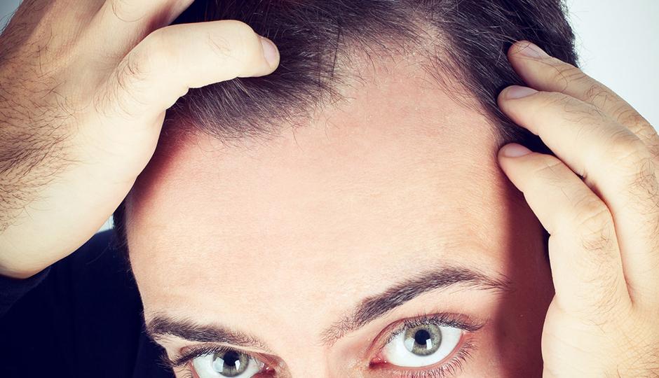 Identifying the Early Stages of Male Pattern Hair Loss
