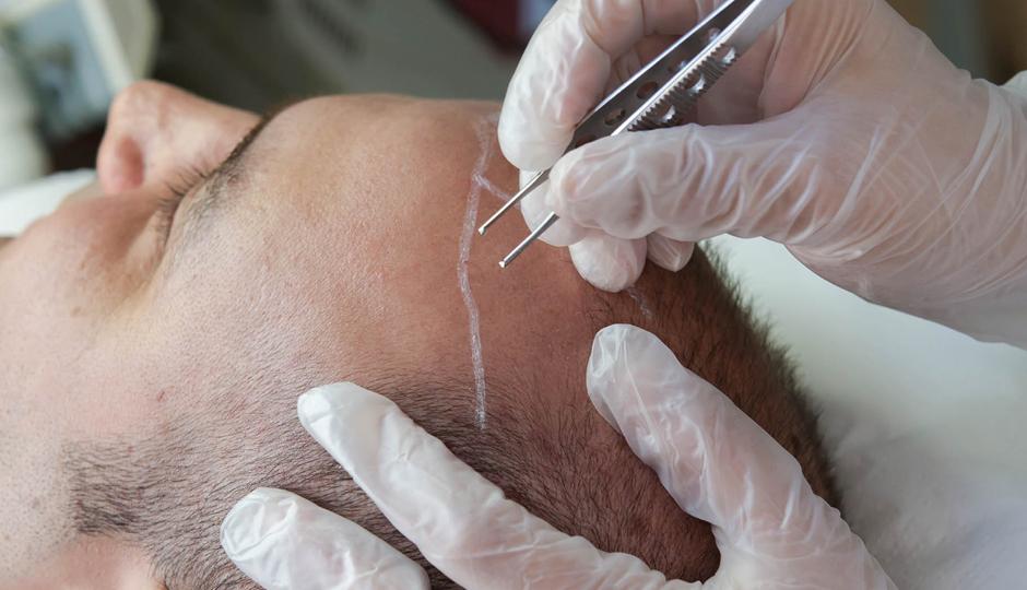 Follicular Unit Extraction Techniques And Equipment