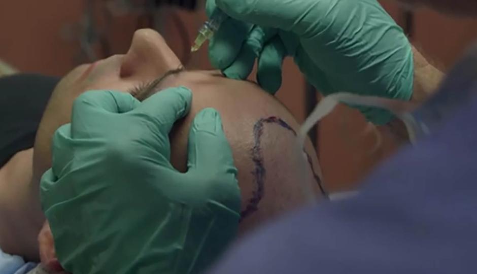 Local Anesthesia in Hair Transplant Surgery