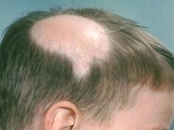 alopeica areata