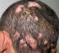 What Causes Fungal Hair Loss?
