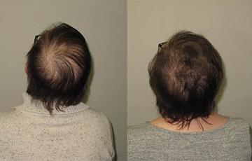 How Hormone Replacement Therapy Can Stop and Reverse Hair Loss  BodyLogicMD