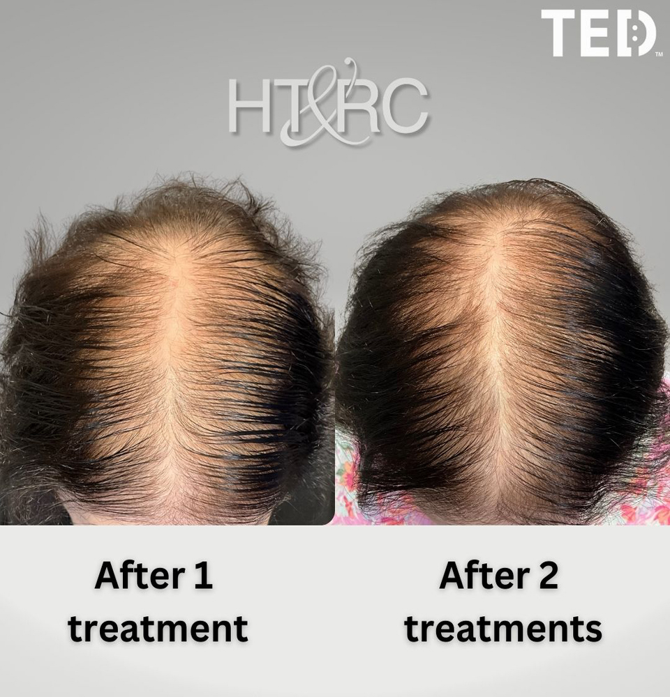 how long does hair shedding last after weight loss 2