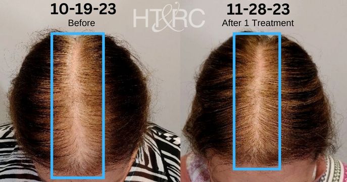 how long does hair shedding last after weight loss
