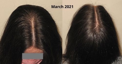 patient in march 2021
