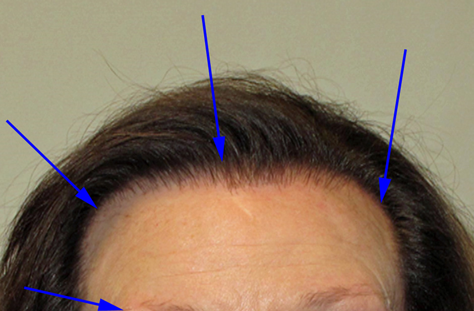 scarring-alopecia-and-peripilar-casts-inline-01 Scarring Alopecia and Peripilar Casts: What I'm Looking For During Consultations