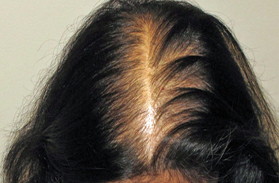 scarring-alopecia-and-peripilar-casts-inline-02 Scarring Alopecia and Peripilar Casts: What I'm Looking For During Consultations