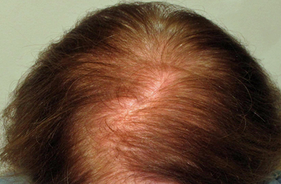 scarring-alopecia-and-peripilar-casts-inline-04 Scarring Alopecia and Peripilar Casts: What I'm Looking For During Consultations