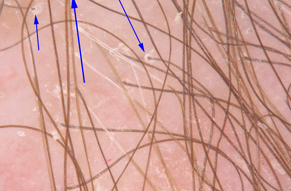 scarring alopecia and peripilar casts inline 08