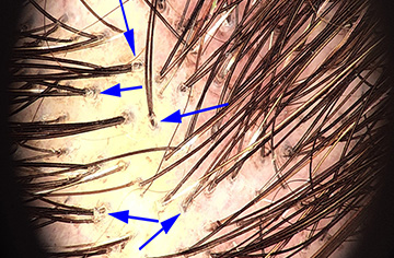 scarring alopecia and peripilar casts inline 09