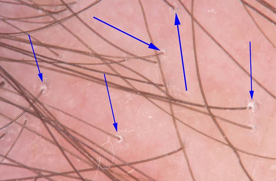 scarring-alopecia-and-peripilar-casts-inline Scarring Alopecia and Peripilar Casts: What I'm Looking For During Consultations