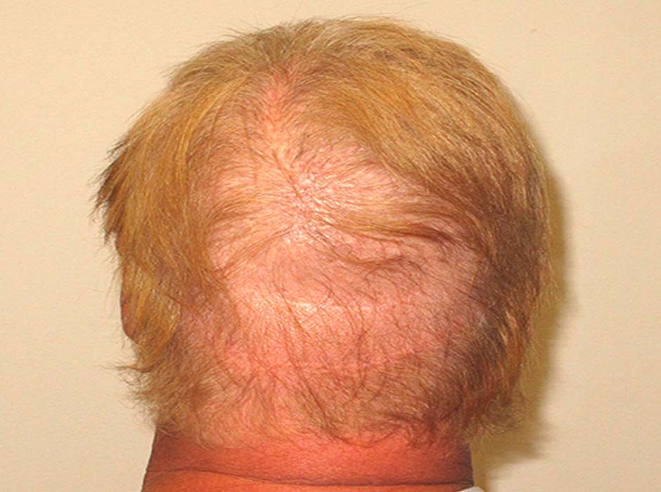 Transplanting Hair Into a Scar: What You Need to Know | HT&RC Transplanting Hair Into a Scar: What You Need to Know | HT&RC