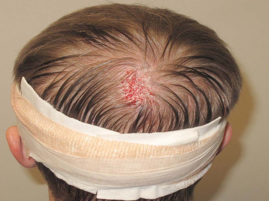 Transplanting Hair Into a Scar: What You Need to Know | HT&RC Transplanting Hair Into a Scar: What You Need to Know | HT&RC