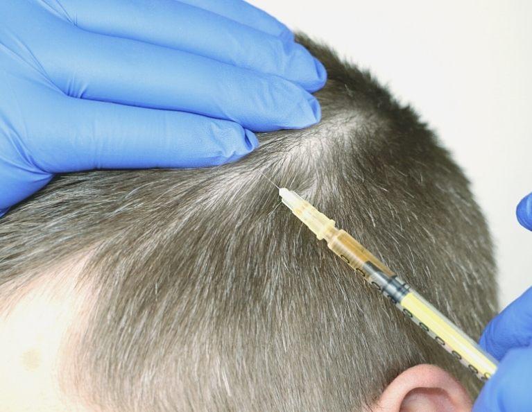 hair follicle regeneration for men