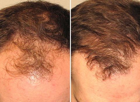 Hair Loss Patient 03