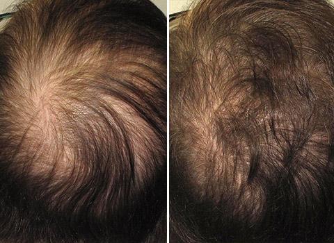 Hair Loss Patient 05
