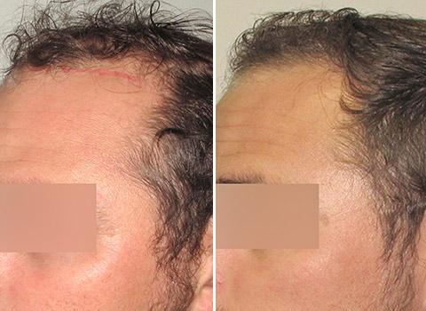 Hair Loss Patient 05