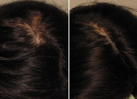 Hair Loss Patient 09