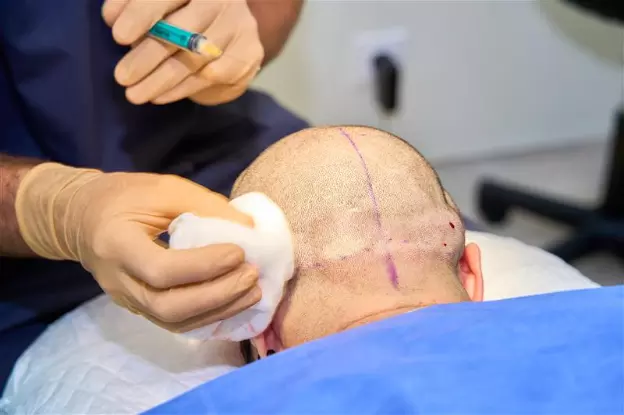 Surgeon administering injection to patient&rsquo;s head during hair transplant