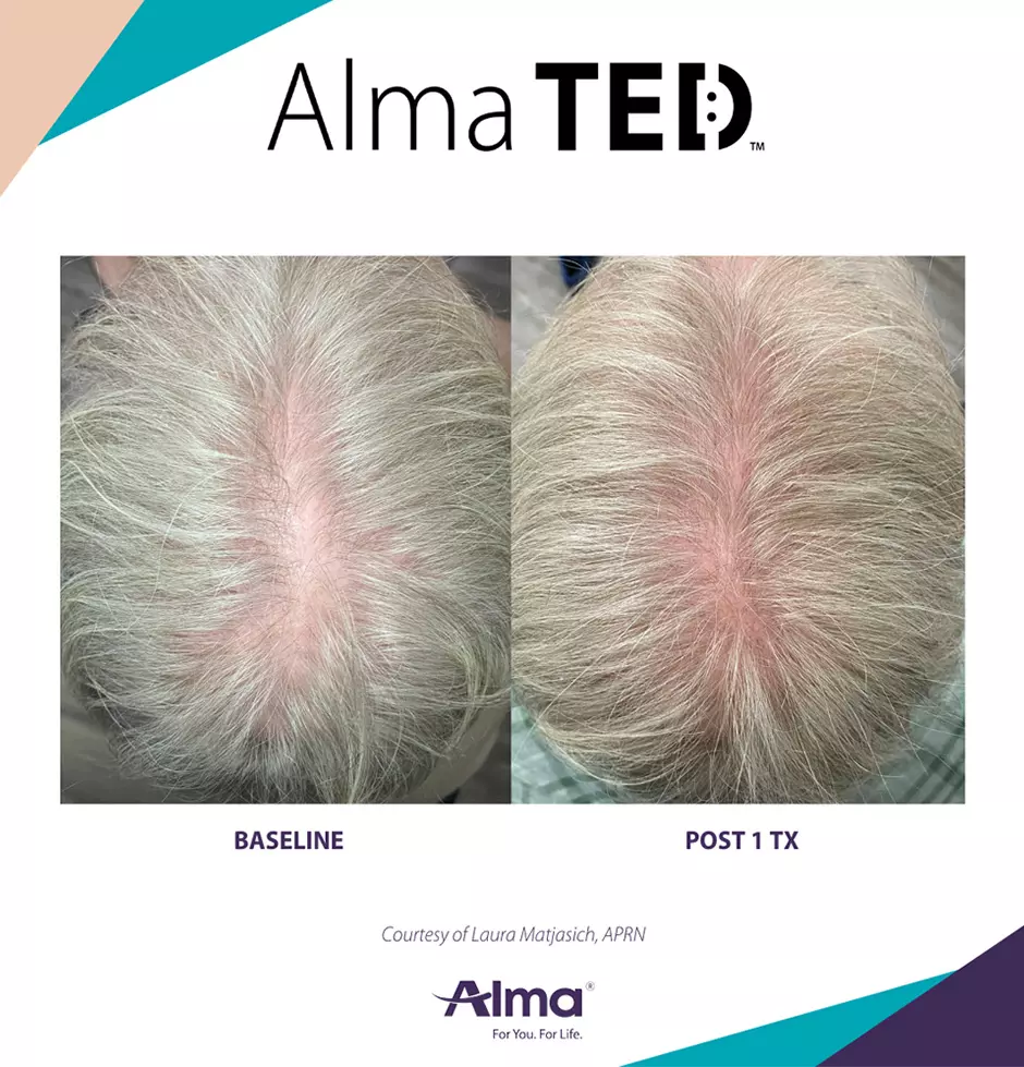 alma ted mens non surgical treatment 8