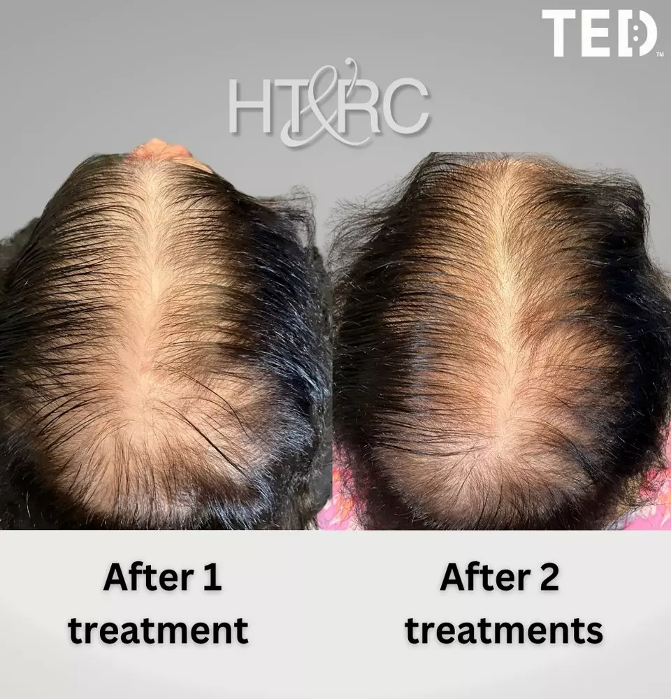 alma ted womens non surgical treatment 9