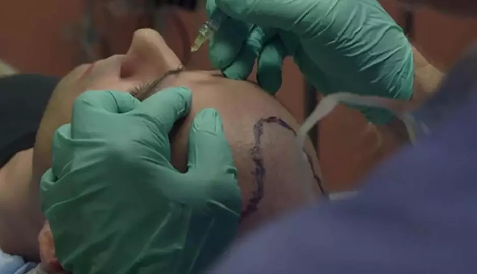 A Closer Look At Follicular Unit Transplant