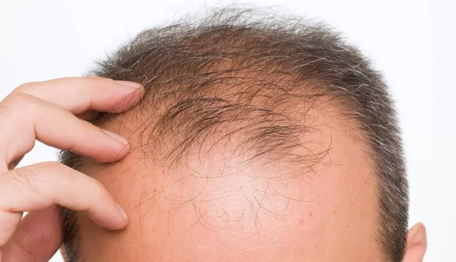 Hair Loss Medicine: Rogaine