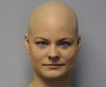 Alopecia Areata 2