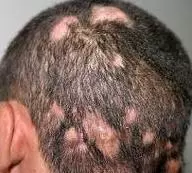 Scalp Infections Causes Symptoms and Treatment