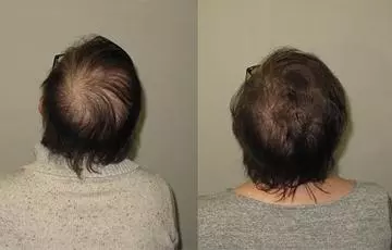 Breast Cancer Patients: Management of Hair Loss in the Face of Endocrine Therapy
