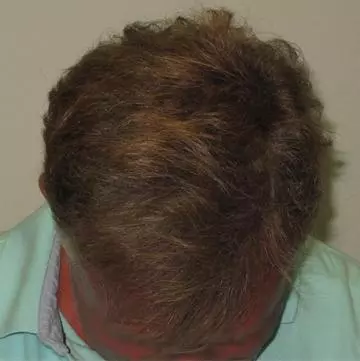 I Still Have Hair, What is a Trichoscope Exam and Why Do I need One? I Still Have Hair, What is a Trichoscope Exam and Why Do I need One?