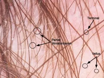 hairline follicles