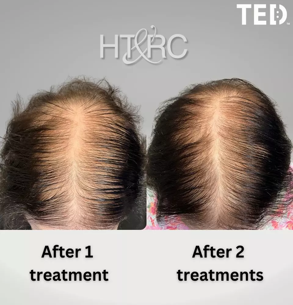 how-long-does-hair-shedding-last-after-weight-loss-2 image how long does hair shedding last after weight loss 2