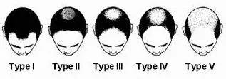 latin hair loss chart