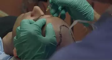 follicular unit transplant
