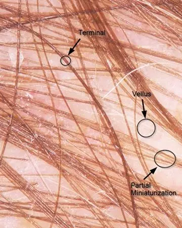 mid vertex hair follicles