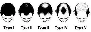 nordic hair loss chart