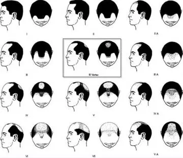 Norwood Vertex Scale