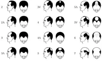 Norwood Hair Loss Scale