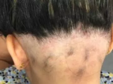 Alopecia Areata 4 Alopecia Areata 4