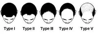 semitic hair loss chart