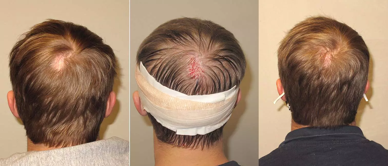 Can Thinning Hair Grow Back? Really? – Revela