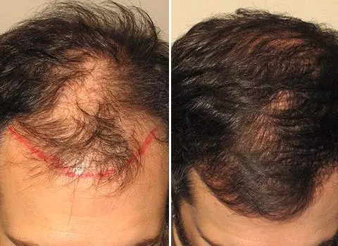 Hair Loss Patient 04