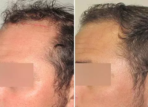 Hair Loss Patient 05