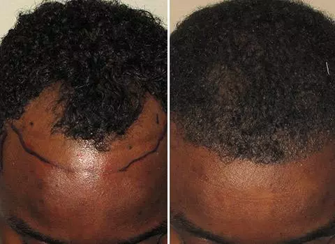 Hair Loss Patient 06