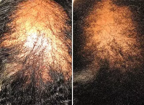 Hair Loss Patient 07
